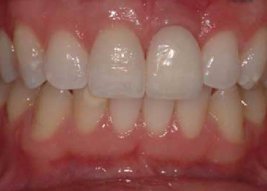 zobu implants trūkstoša priekšējā zoba vietā